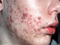 Desarrollan una Vacuna contra el Acné