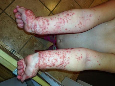 Esta popular actividad infantil está causando consecuencias devastadoras