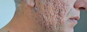 ¿Es hora de descartar los mitos y temores sobre la psoriasis?