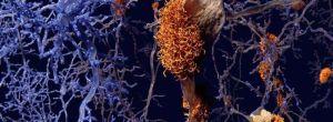 Parkinson: la proteína modificada funciona como una droga