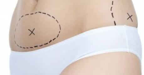 Lipoescultura VS Liposucción