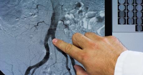Complicaciones de la urografía