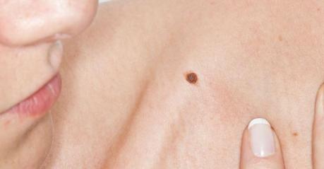 Sarcoma Sarcoma de tejidos blandos