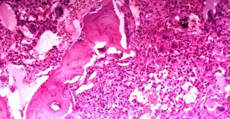 Sarcoma Pronostico sarcoma