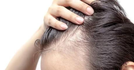 Ventajas y desventajas del injerto capilar