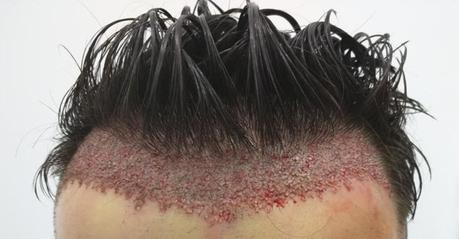 Injerto capilar en Turquía