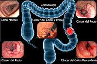 Las Bacterias y el Estrés Celular causan el Cáncer de Colon