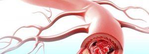 La inflamación afecta el proceso de formación de placa en las arterias