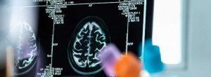 Un nuevo estudio muestra cómo el cerebro le indica al sistema inmune que active un mecanismo de EM
