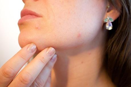 ¿La vitamina B puede provocar acné?