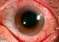 Enfoque de Tratamiento para la Uveítis No infecciosa