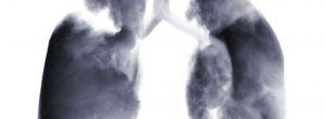 Densidades sospechosas en los pulmones: relacionados con la infección por hongos ¿histoplasmosis?