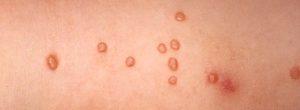 ¿Cuál es el mejor tratamiento para el molusco contagioso?