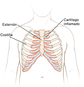 Artricenter: Costocondritis, una causa de dolor de pecho en Fibromialgia Captura de pantalla 2013-08-23 a las 17.18.47