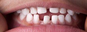 Problemas con las encías: gingivitis (inflamación de las encías) Vs. periodontitis (enfermedad de las encías) Las espacios entre mis dientes continúan haciéndose más amplios: ¿por qué sucede esto y cómo se puede detener?