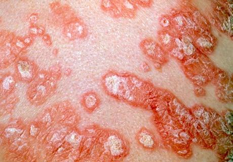 El acné comienza debajo de la piel, pero la psoriasis es inmediatamente visible en la piel