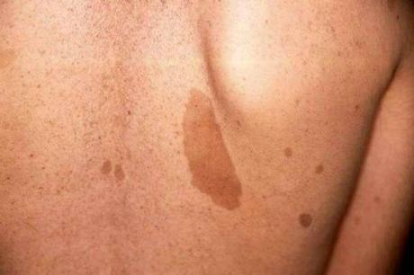 Neurofibromatosis: opciones de tratamiento y esperanza de vida