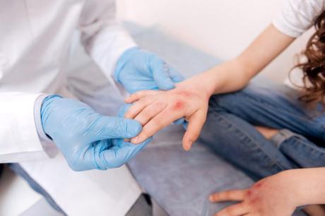 ¿Pasarán por sí solos los síntomas de la alergia a los mariscos o requerirá tratamiento?