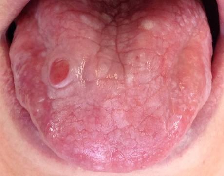Úlceras bucales de Crohn: Qué saber La glositis puede ser un síntoma de la enfermedad de Crohn