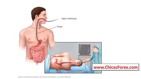 Consejos dietéticos para la gastritis y úlceras estomacales.