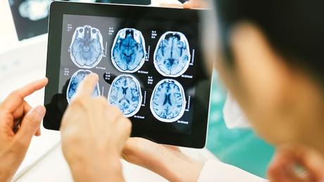 5 cosas que debe saber después de haber tenido un accidente cerebrovascular o que haya tenido un ser querido