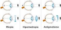 La miopía y la hipermetropía se desarrollan por diferentes vías moleculares
