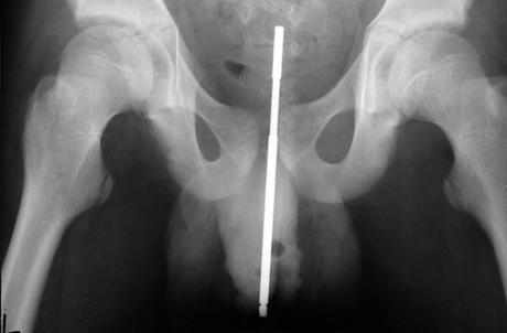 ¿Qué hacer cuando un objeto extraño se atasca en su uretra?