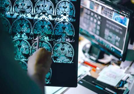 Los nuevos medicamentos se dirigen al gen APOE4 , que se cree que contribuye al desarrollo de la enfermedad de Alzheimer.