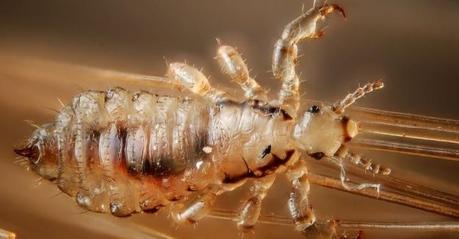 Remedios caseros para eliminar los piojos Causas de los piojos