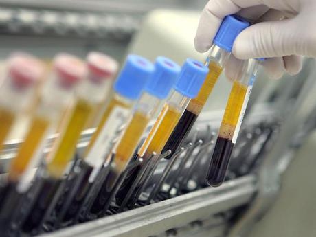 Los investigadores están trabajando arduamente para desarrollar un análisis de sangre 