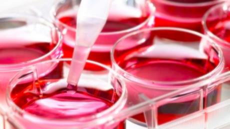 ¿Qué son las células madre y qué hacen? Los trasplantes con células madre ya están ayudando a las personas con enfermedades como el linfoma