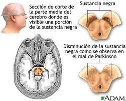 Nuevos avances en el Mal de Parkinson