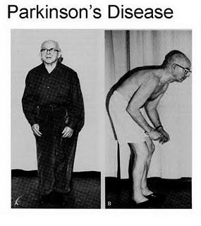 Nuevos avances en el Mal de Parkinson