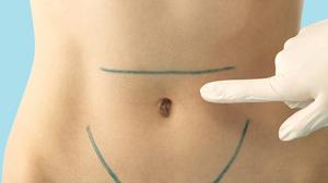 ¿En qué consiste la abdominoplastia?
