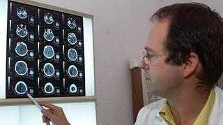 Las seis señales de alarma del ictus cerebral