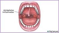 Amigdalitis y adenoiditis