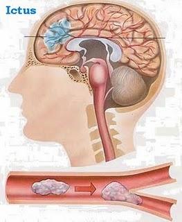 Cómo reconocer un ictus (infarto cerebral)