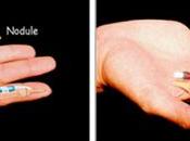 Artricenter: Dedo gatillo, posible complicación Artritis Reumatoide