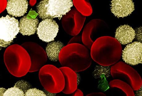 Sepsis Sepsis