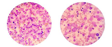 Frotis de sangre que muestra neutrófilos, glóbulos blancos y leucemia
