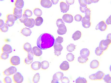 Todo lo que necesitas saber sobre la médula ósea Hay tres tipos de linfocitos. Linfocitos T, linfocitos B y células asesinas naturales.