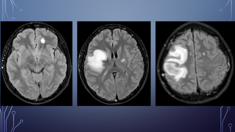 CASO CLINICO DE NEUROLOGIA