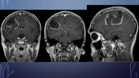 CASO CLINICO DE NEUROLOGIA
