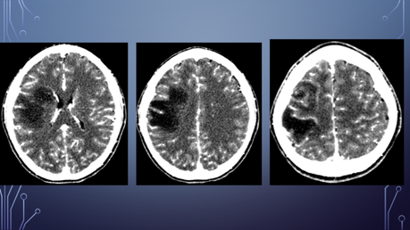 CASO CLINICO DE NEUROLOGIA