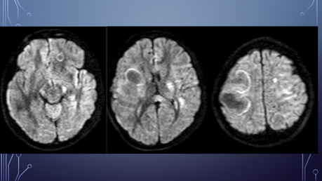 CASO CLINICO DE NEUROLOGIA
