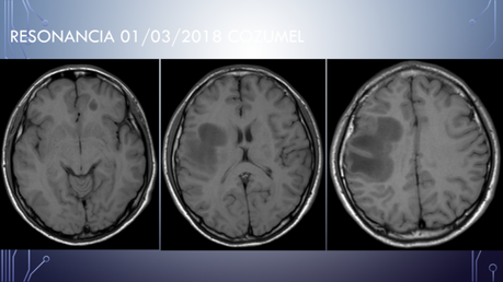 CASO CLINICO DE NEUROLOGIA