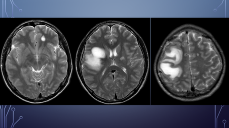 CASO CLINICO DE NEUROLOGIA
