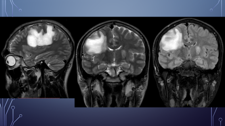 CASO CLINICO DE NEUROLOGIA