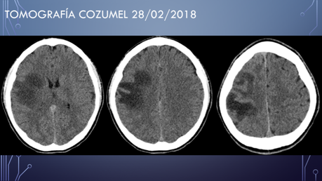 CASO CLINICO DE NEUROLOGIA