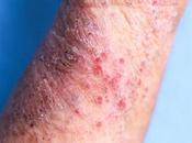 ¿Los baños lejía pueden ayudar tratar eczema?